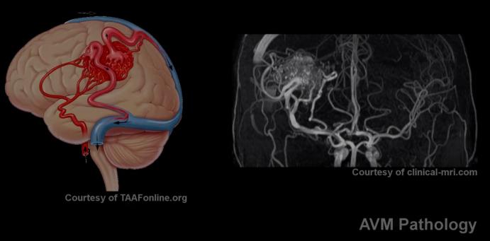 Figure 1. Depiction of an AVM nidus, feeding arteries and draining veins.