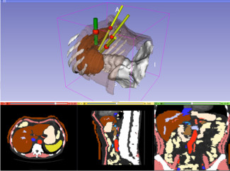 Patient-specific port placement visualized in Slicer