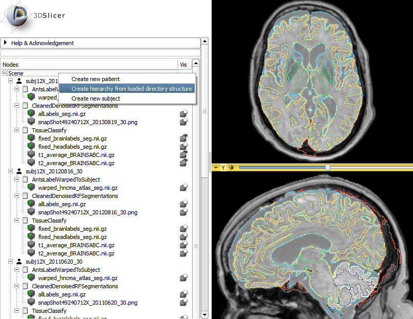 SlicerRT_0.13_HuntingtonsLongitudinalInSubjectHierarchy2