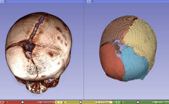 Image Guided Surgical Planning