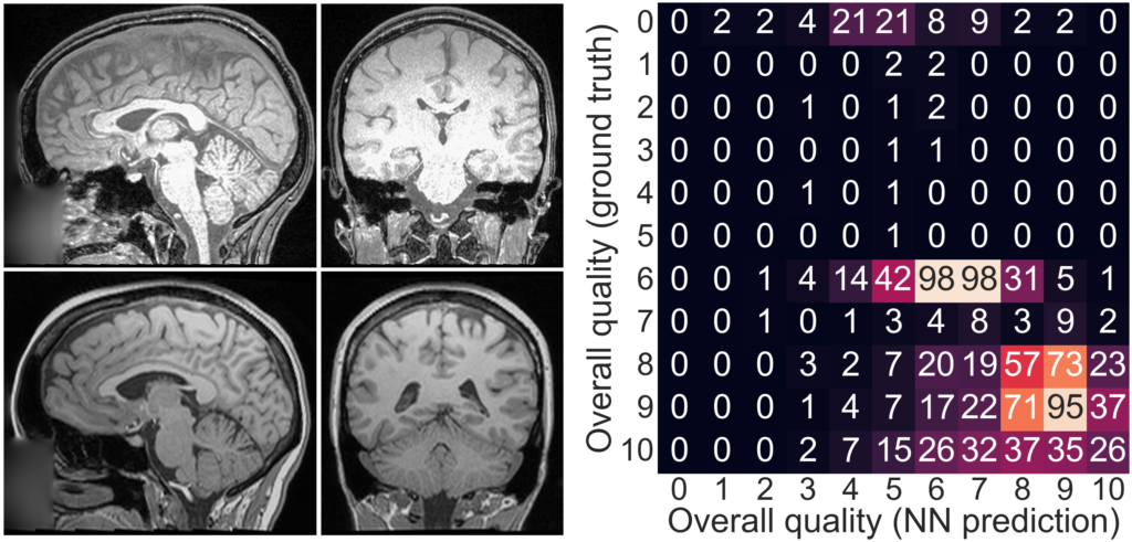 2 brain MRIs and QA confusion matrix