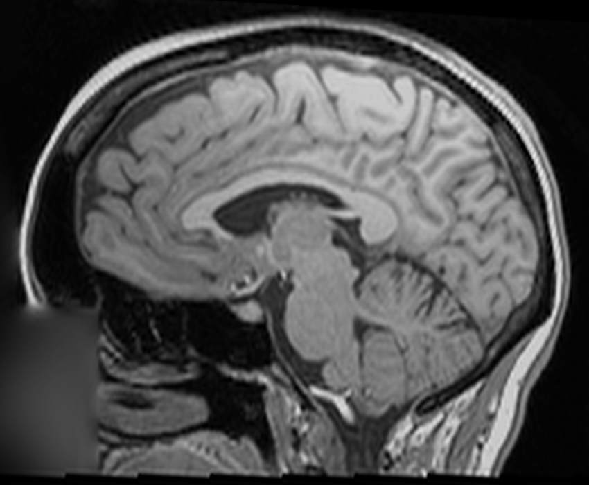 Sagittal brain MRI