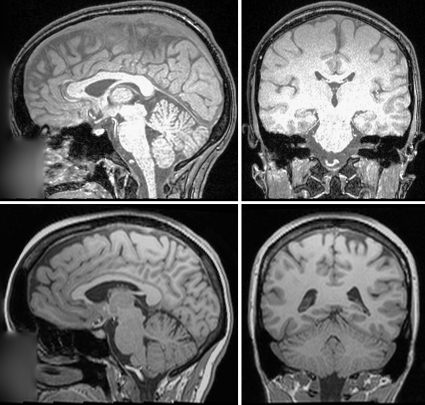 Slices of two brain scan images