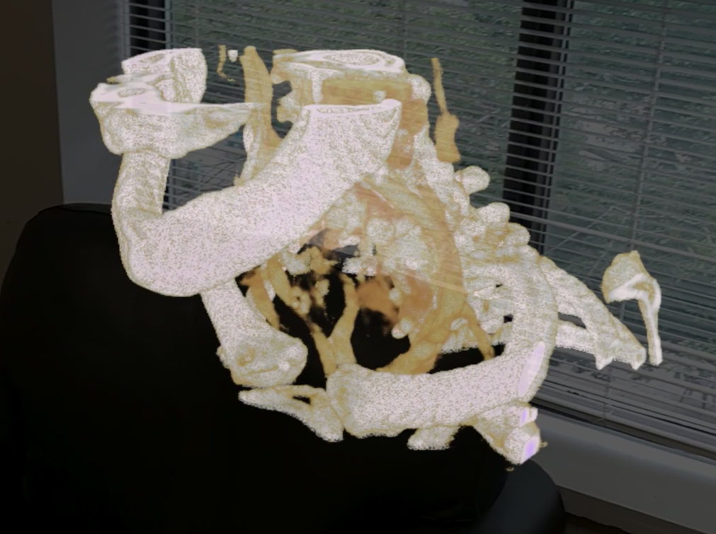 A medical volume rendering on a Microsoft HoloLens 2 headset as seen from the user’s perspective. This rendering depicts a CT scan subvolume centered on a patient’s neck.
