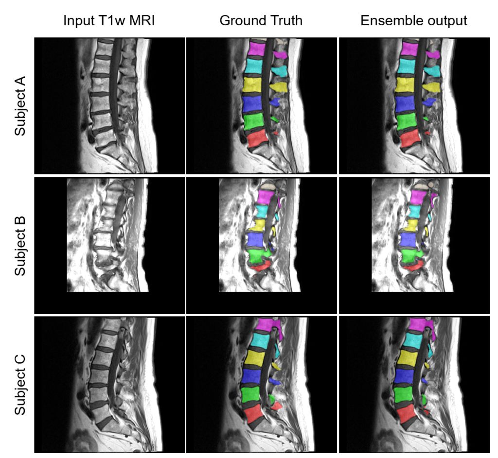 Example segmentation predictions from Auto3DSeg applied to lumbar spine segmentation in MRI