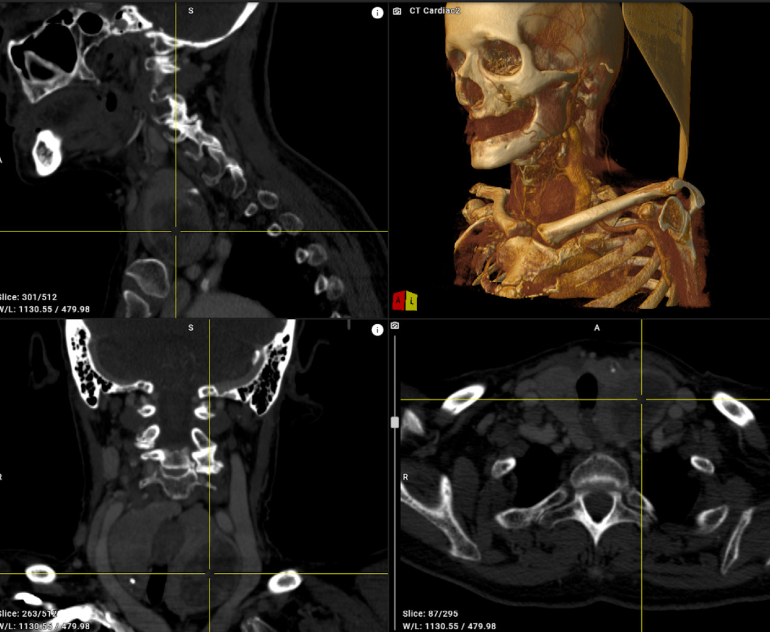 Screenshots of Volview showing skeleton structure and xray version of it.