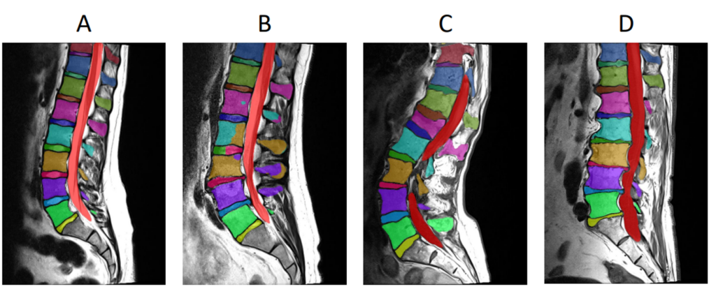 Baseline results of nnU-Net on SPIDER Lumabr spine segmentation dataset