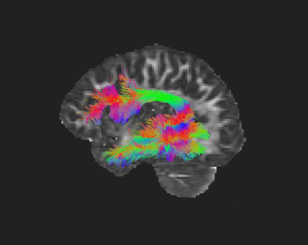 White matter tracts