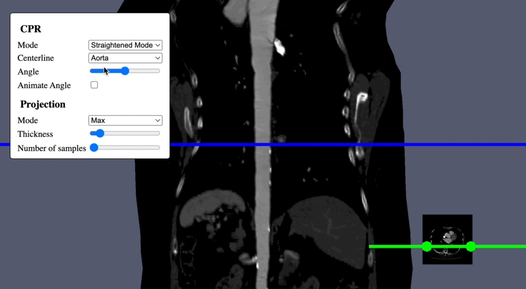 The new curviplanar reformatting mapper allows for 2D slicing of a volume along an arbitrary 1D curve. In the example shown above, the volume is resliced to keep the aorta as a straight line, deforming the rest of the image around it.