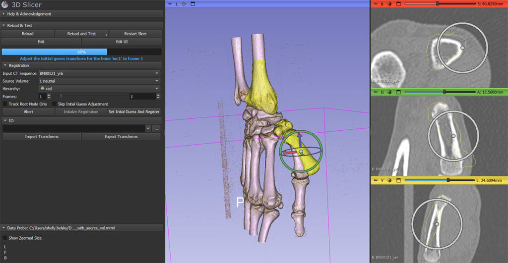 AutoscoperM Hierarchical 3D Registration in Action: AutoscoperM’s Hierarchical 3D Registration extension for 3D Slicer automates six-DOF rigid alignment of skeletal anatomy. In this example, tracking a metacarpal bone across a 3D CT sequence. It defines ROIs around each bone, registers the root node first, then propagates optimized transforms through the anatomical hierarchy for accurate motion and kinematic analysis.