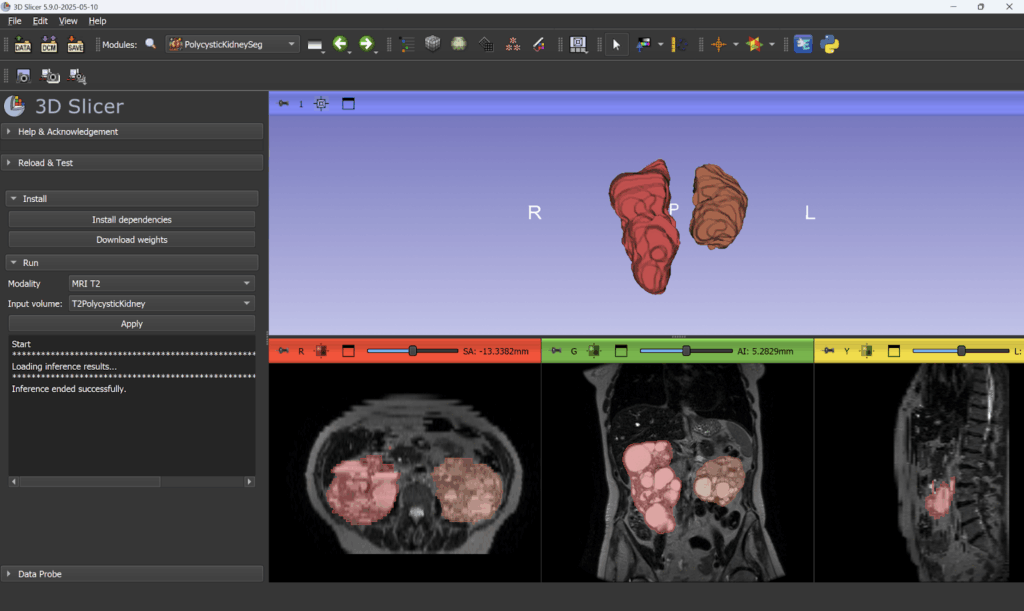 Screenshot of the PolycysticKidneySeg 3D Slicer extension