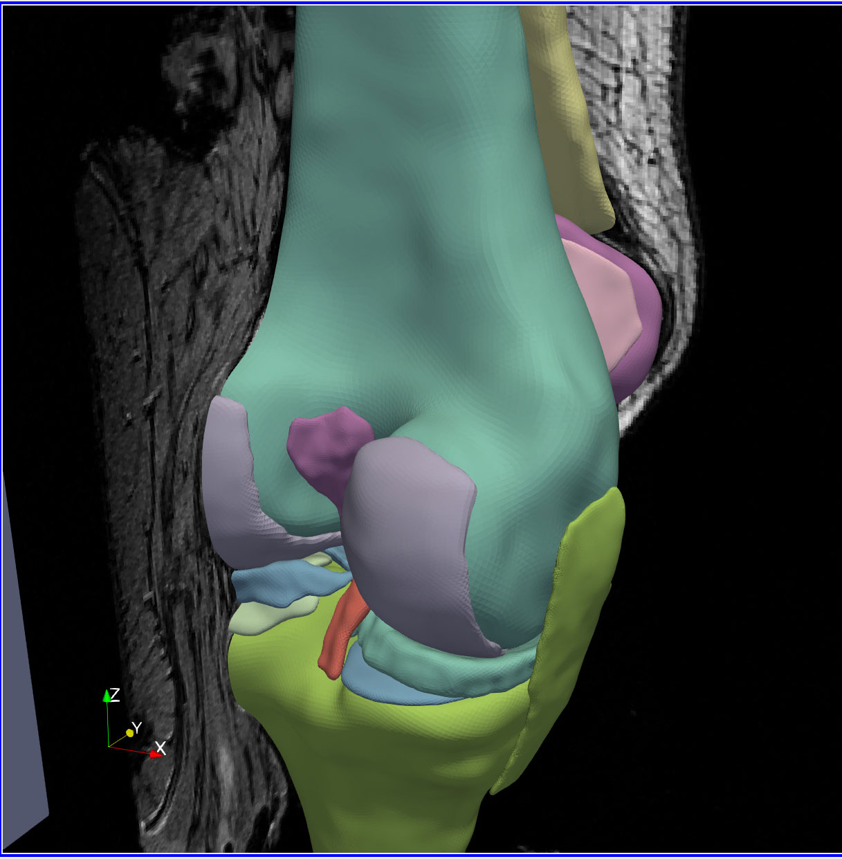 Figure Y. Developed for the Cleveland Clinic, this workflow showcases the intricate process of creating and annotating anatomical models. This involves segmenting and processing medical images and meshes. Users needed efficient ways to create and edit surface selections, remesh surfaces, and generate volumetric meshes from them, as well as to incorporate detailed ontologies into the annotation process. Frameworks used: SMTK, CMB, ParaView, VTK