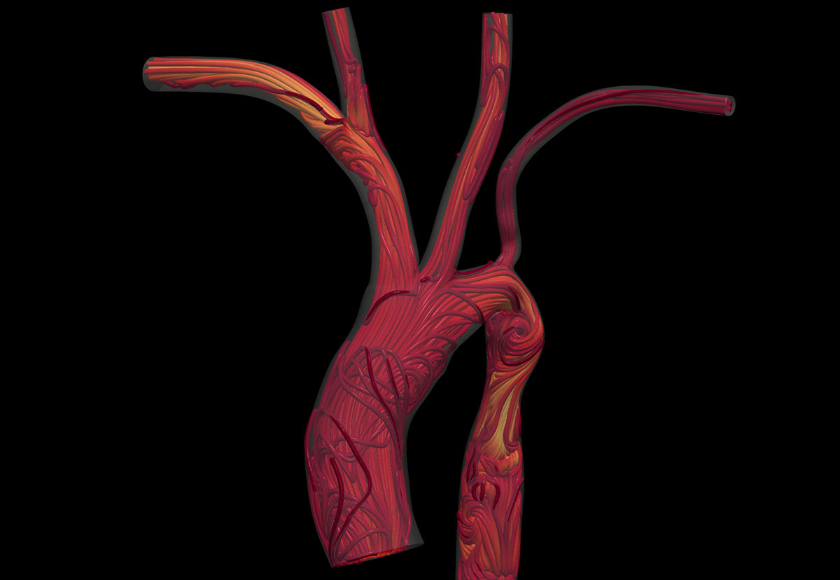 Computational fluid dynamics (CFD) is integral to whole-body circulatory system workflows, supporting the development of new surgical procedures and patient health monitoring. These workflows often run continuously, necessitating in situ visualization for real-time observation by physicians and researchers. The accompanying images illustrate work from the Randles Lab at Duke University, where methods for whole-body circulatory system simulation are being developed, modeling down to individual blood cells using the HARVEY fluid dynamics solver. The video showcases blood flow within a representative human aorta, originating at the ascending aorta, traversing the aortic arch, and concluding at the descending aorta. As the fluid enters the aortic arch, it diverges into the right and left subclavian and common arteries. To mimic in vivo circulation, the flow constantly pulses throughout the animation. Frameworks used: ParaView, ParaView Catalyst Frameworks used: ParaView, Catalyst