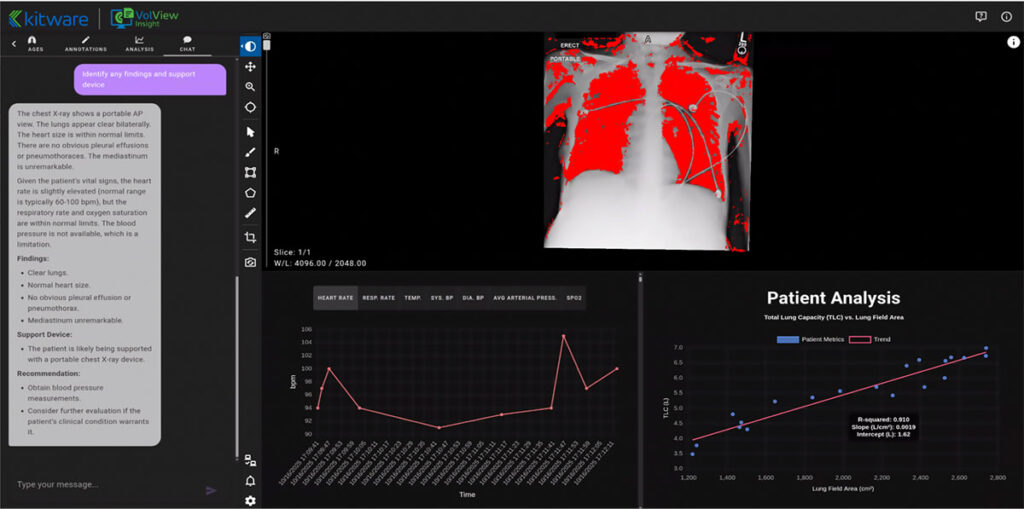 Screenshot of VolView software showing patient analysis