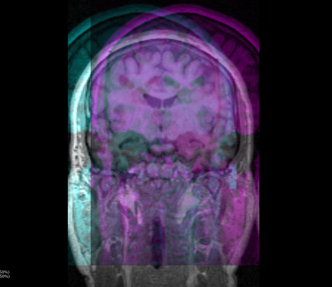 Screenshot of 3d Slicer software showing Demonstration of multiple-layer managing and blending in 3D Slicer