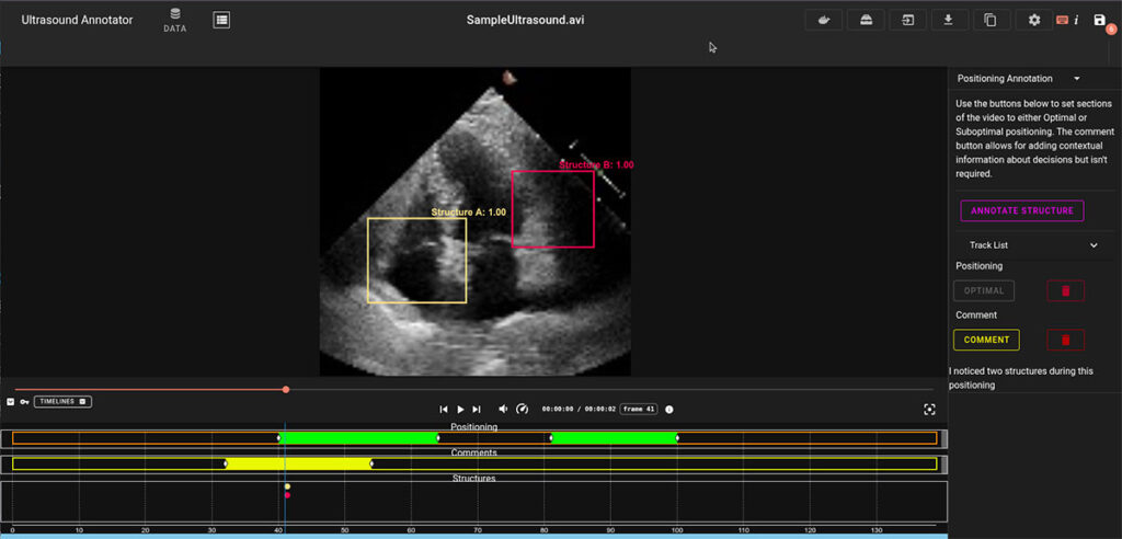 The Echo Annotator, a DIVE customization developed for the ARPA-H Saving Baby Hearts program, shown here labeling neonatal ultrasound video of an infant heart. These annotations train AI-enabled devices that optimize ultrasound positioning and improve earlier and more accurate diagnosis of congenital heart defects, saving babies’ lives.