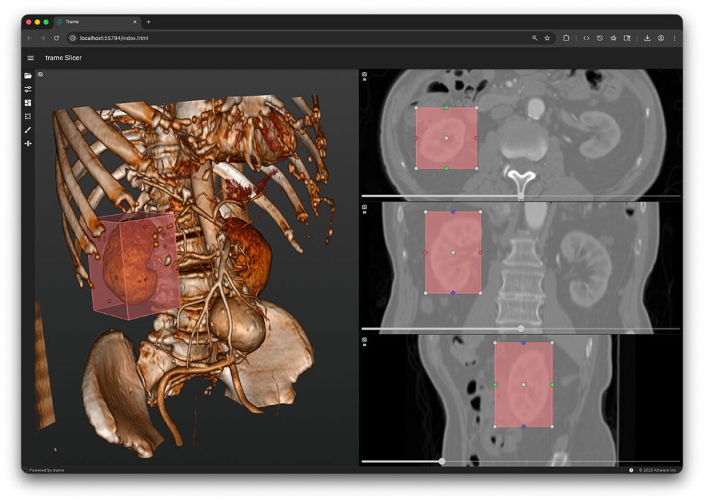 Screenshot of trame Slicer software showing kidneys highlighted.