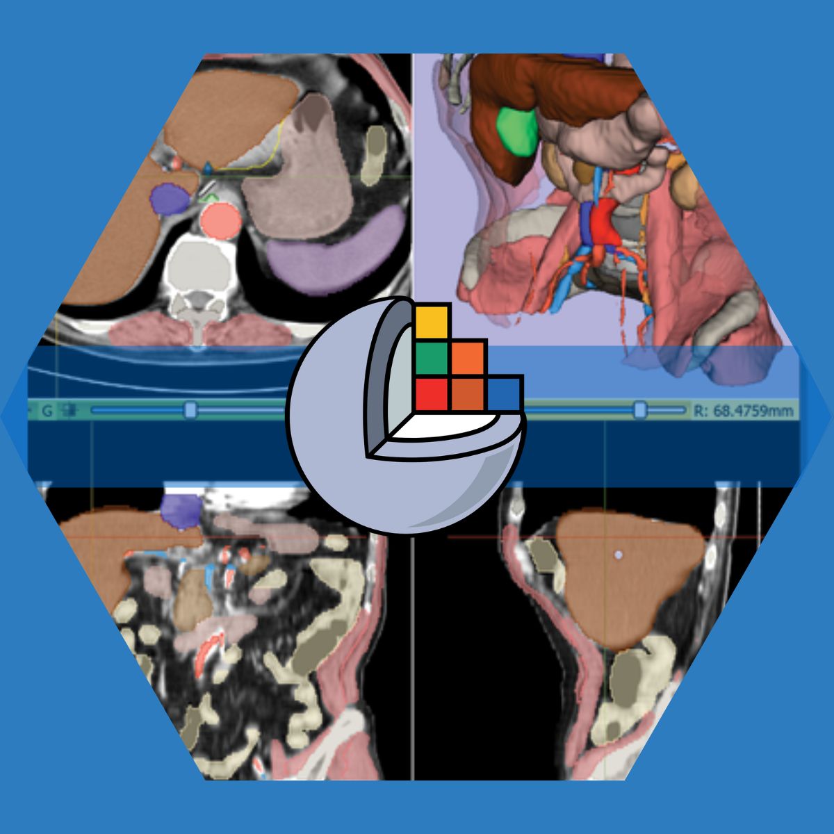 Screenshots of 3d slicer software with the 3d slicer logo over it