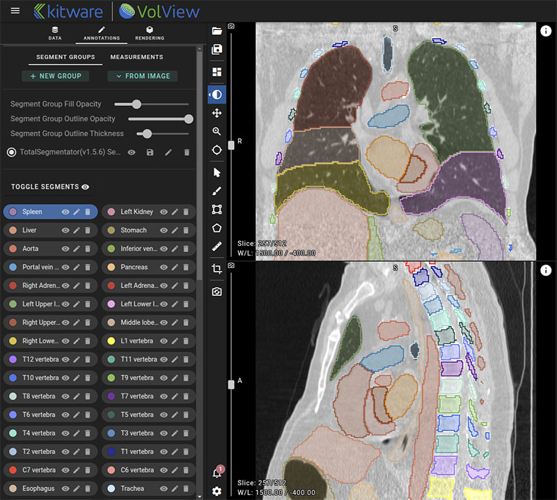Screenshot of VolView showing chest cavity.