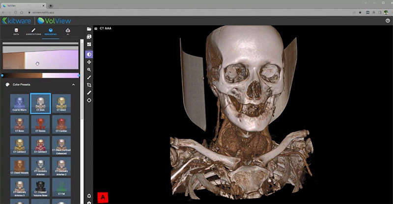 Screenshot of VolView software showing a skeleton
