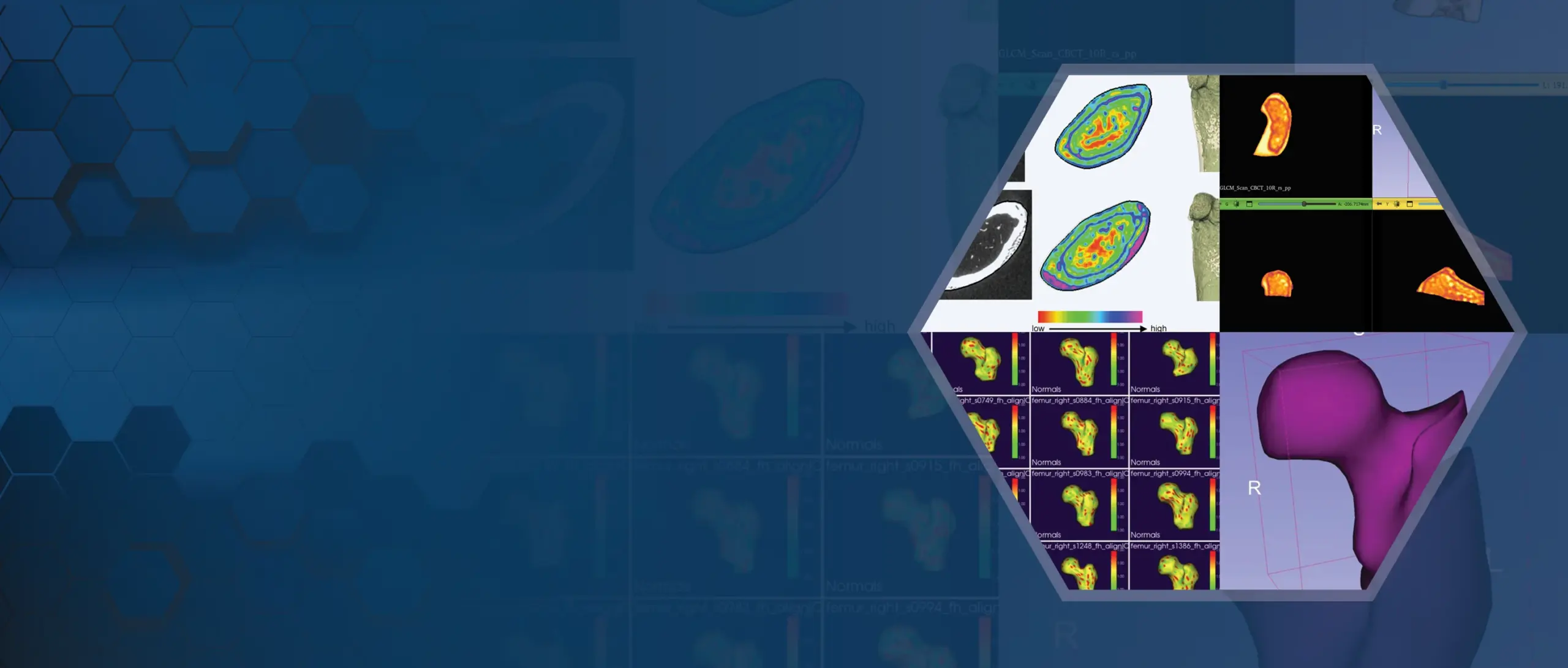3D bone imaging and heatmap density scans displayed in a hexagonal frame on a blue tech background