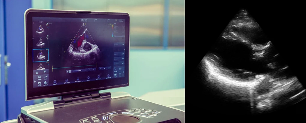 Two-panel graphic featuring a portable ultrasound machine screen showing a color Doppler cardiac scan on the left, and a corresponding high-contrast, black-and-white echocardiogram image of a heart on the right.
