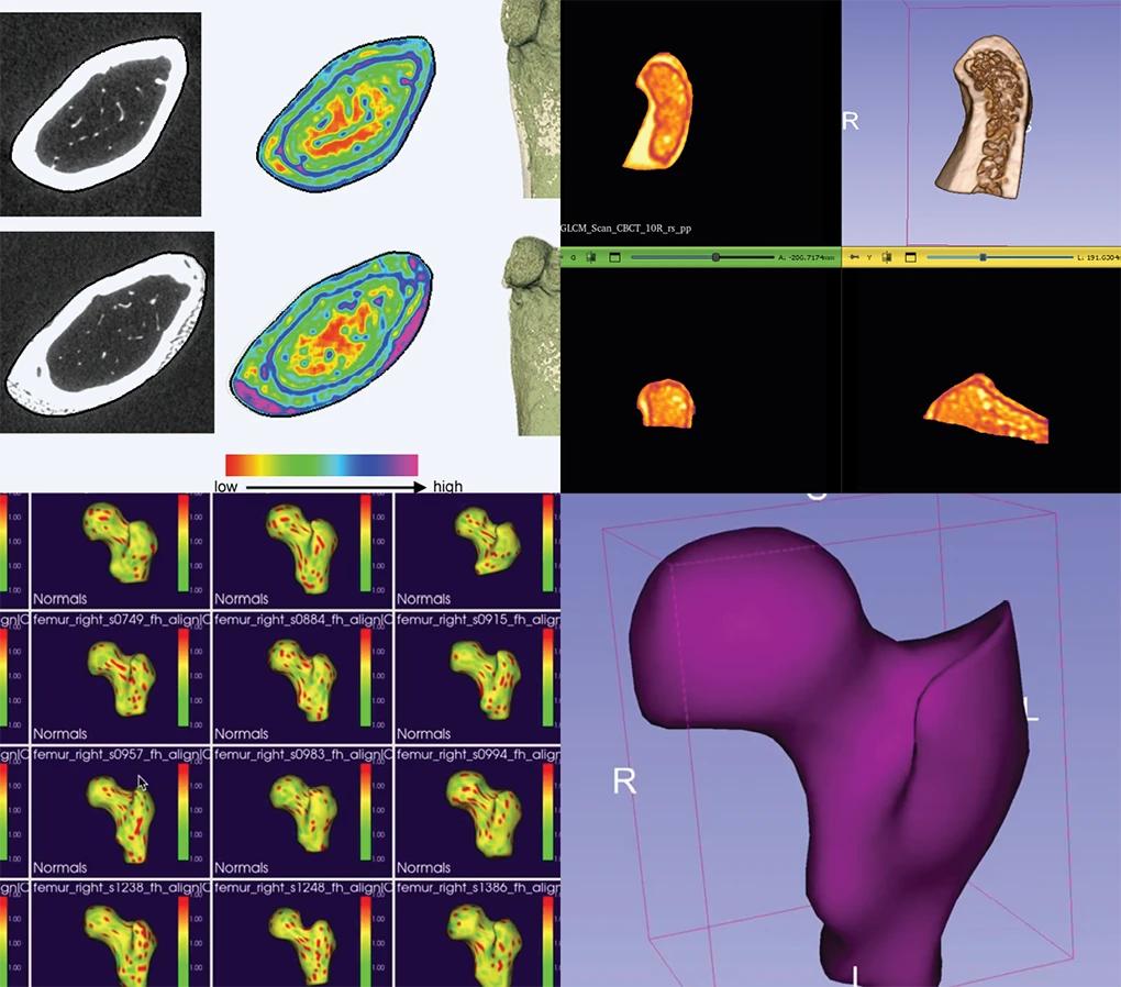 A collage of advanced medical imaging scans and 3D reconstruction models analyzing bone density and structure in a femur.
