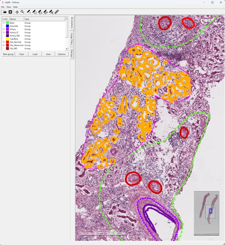 Figure 1: Screenshot of a case in ASAP viewing and annotation program. This is one of 100 manually segmented WSIs (whole slide images) Mount Sinai shared with Kitware. Green outline denotes areas of the slide where glomeruli and arteries were segmented. Bright purple outline denotes areas of the slide where tubules are segmented. Darkest purple denotes arterial intimal fibrosis.