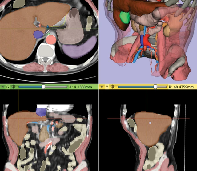 A 3D Slicer multi-view interface displaying 2D CT scan cross-sections and a corresponding 3D anatomical reconstruction with segmented abdominal organs.