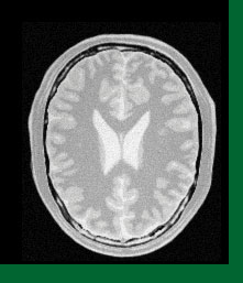 A grayscale axial brain MRI scan showing cerebral cortical structures and lateral ventricles set against a dark frame with a green border stripe.